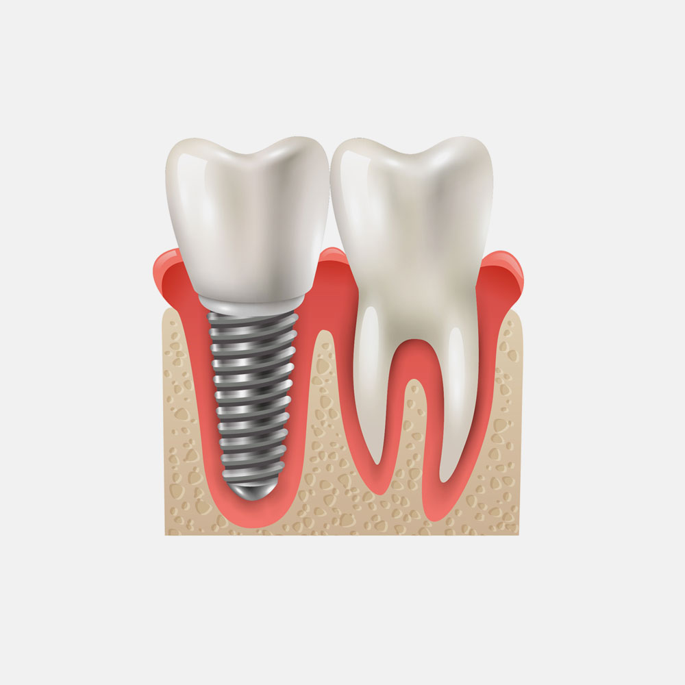 dental implant dentist in mississauga
