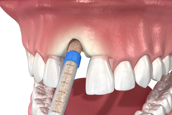 Sinus Lift Surgery in Mississauga Dental Implants in Mississauga Dental Implant Cost in Mississauga Missing Tooth in Mississauga dental implant cost in Mississauga Dental Implant Procedure in Mississauga