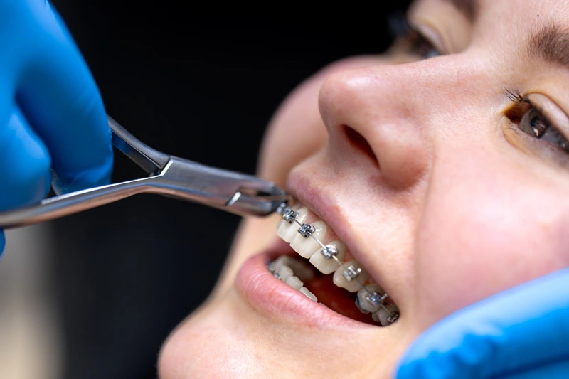 Metal braces - orthodontics treatment in Mississauga